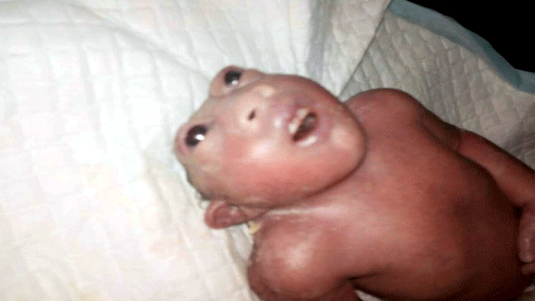 Child born with half a head in Kurdistan dies after an hour